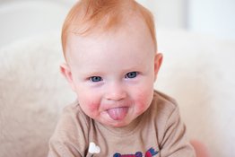 Chàm sữa ở trẻ: nguyên nhân và cách chăm sóc trẻ phù hợp