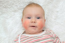 Viêm da ở trẻ sơ sinh: nguyên nhân và cách điều trị