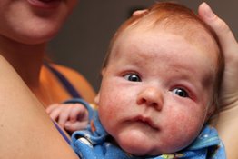 Trẻ sơ sinh bị khô da: Bố mẹ nên chăm sóc thế nào cho đúng?