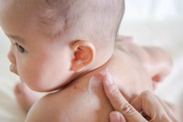 Trẻ sơ sinh bị muỗi đốt sưng đỏ: Bố mẹ phải làm sao? 