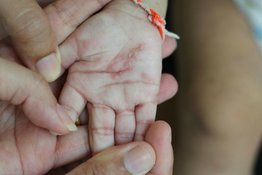 Những điều bố mẹ nên biết về bệnh vảy nến ở trẻ sơ sinh
