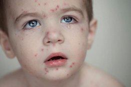 Triệu chứng bệnh thuỷ đậu ở trẻ em bố mẹ không nên bỏ qua