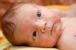 Trẻ sơ sinh bị nốt đỏ ở mặt: Phân biệt nguyên nhân và cách chăm sóc phù hợp