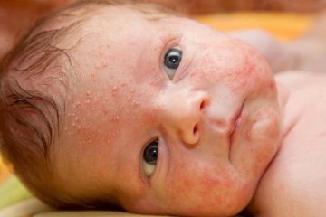 Trẻ bị rôm sảy phải làm sao? - Bí kíp giúp trẻ mau khỏi bệnh