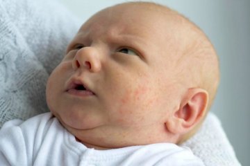 Bé bị chàm sữa mẹ kiêng ăn gì và nên ăn gì?