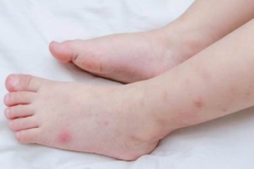 Bé bị nổi mề đay, bố mẹ phải làm sao? 