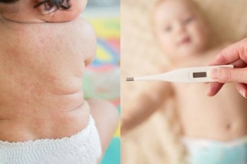 Trẻ em bị sốt phát ban phải làm gì?