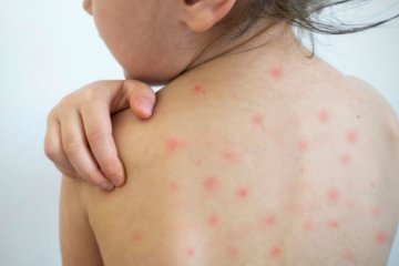 Bố mẹ phải làm sao khi bé bị lên sởi?