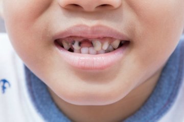 Sâu răng cửa ở trẻ em: nguyên nhân và cách khắc phục hiệu quả