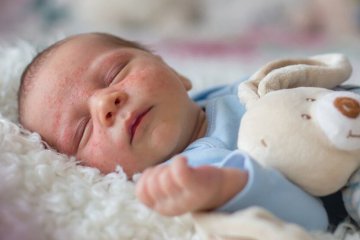 Trẻ bị mụn nhọt trên đầu: Nguyên nhân và cách điều trị