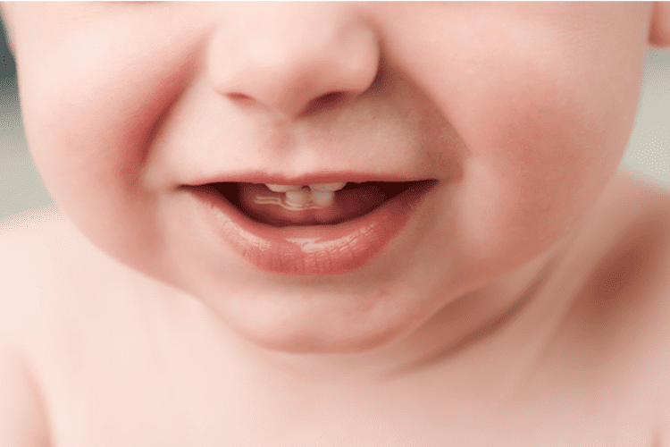 nguy cơ bé bị sâu răng sữa có thể hình thành từ trước khi bé mọc răng sữa