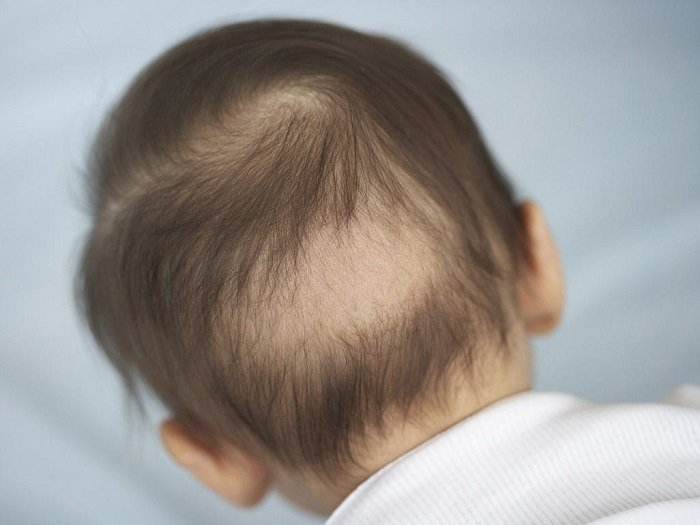 Trẻ sơ sinh bị rụng tóc theo từng mảng.