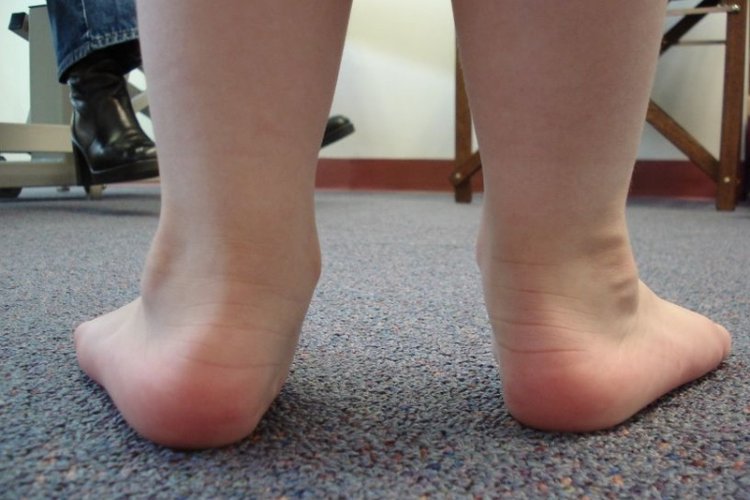 biến chứng của hội chứng bàn chân bẹt