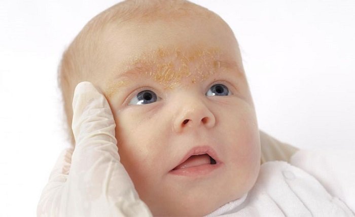 Hình ảnh viêm da ở trẻ sơ sinh