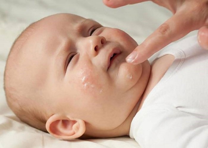 Bôi thuốc cho em bé bị viêm da ở trẻ sơ sinh.