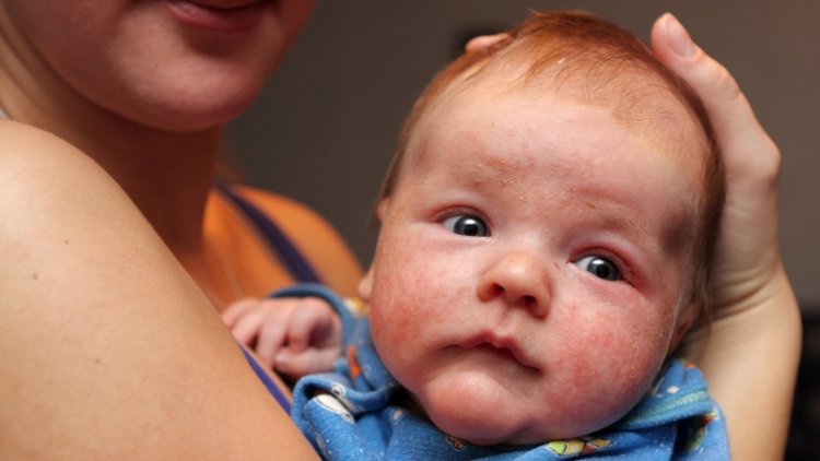 trẻ sơ sinh bị khô da do mắc bệnh chàm eczema