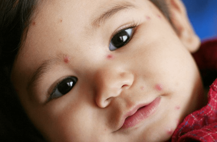 Một trong những triệu chứng bệnh thuỷ đậu ở trẻ em rõ rệt nhất những nốt đỏ trên da gây ngứa.