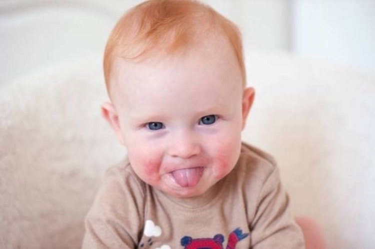 trẻ sơ sinh có nốt đỏ trên mặt do chàm sữa