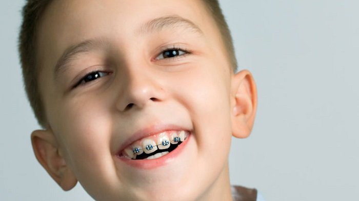 Trẻ bị hô xương hàm là tình trạng do việc răng sữa sau khi bị thay mọc xấu, mọc lệch và lộn xộn.